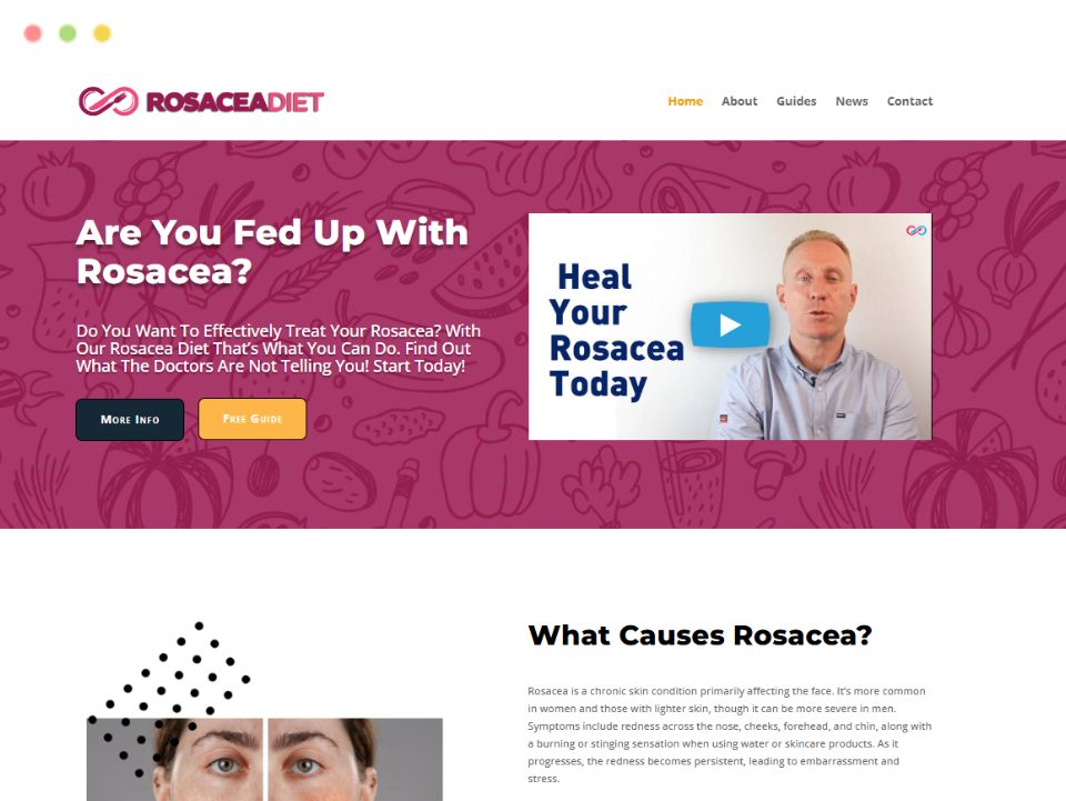 rosacea-diet-webpage